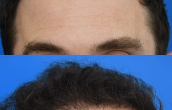 male patient before and after FUE Hair Transplantation