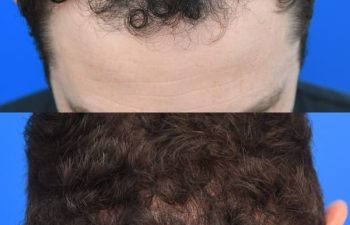 male patient before and after FUE Hair Transplantation