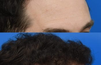 male patient before and after FUE Hair Transplantation