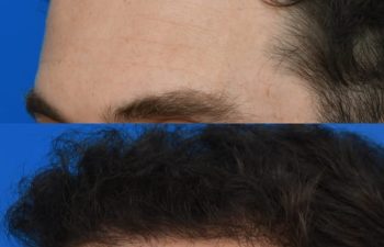 male patient before and after FUE Hair Transplantation